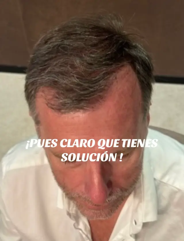 La Alopecia androgenica tiene solución, presentó este caso de un paciente de 60 años con una cirugía FUSS anterior con mal resultado . Le indique protocolo de Recuperación capilar y un Implante capilar FUE . Resultado impecable . #alopeciaandrogenetica #implantecapilar #recuperacioncapilar #medicinacapilar #alopecia