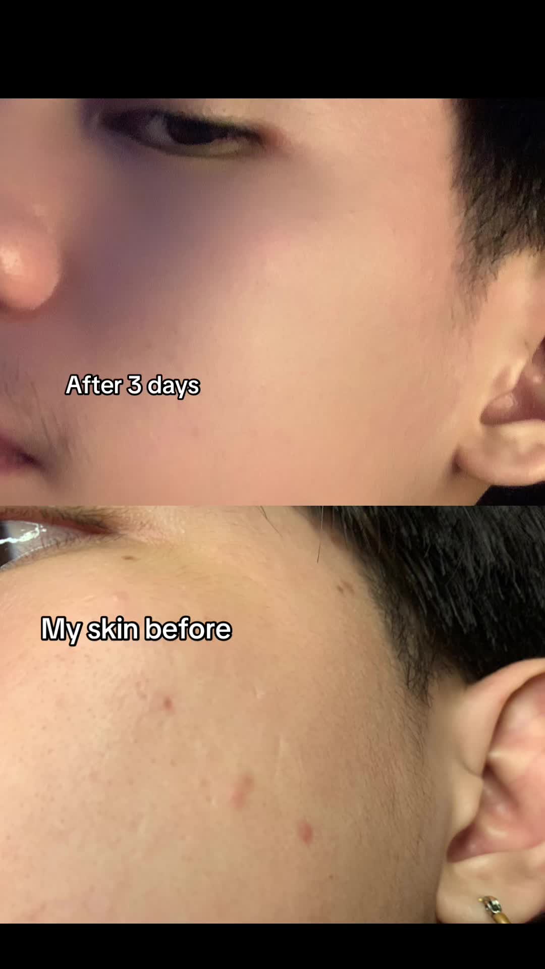 try it now #drleo #acnebuster #acnetreatment #acnesolution