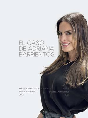 ✨ Adriana Barrientos comparte su experiencia en medicina capilar junto al Dr. Ignacio Beltrán, director médico de Clínica Apolo. 🙋♀️ En esta entrevista real, Adriana revela cómo la medicina capilar personalizada le devolvió confianza y resultados visibles. 👉 Si sufres caída del cabello, alopecia o pérdida de densidad, la medicina capilar en Clínica Apolo es la solución para hombres y mujeres. 📍 Atención en Santiago (Las Condes) y La Serena. 🔗 Agenda tu evaluación en 👉 clinicaapolo.cl #MedicinaCapilar #ImplanteCapilar #DoctorIgnacioBeltrán #ClínicaApolo #RecuperaciónCapilar