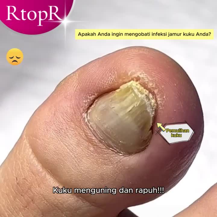 【TERSEDIA&COD】10Ml RtopR Jahe Antibakteri Perawatan Kuku Esensi Perbaikan Kuku Rusak Meningkatkan Pertumbuhan Kuku Anti Infeksi Jamur Kuku Kaki Menyusui Anti Infeksi Paronychia Onikomikosis Cairan Perawatan Kuku Kelembapan 14