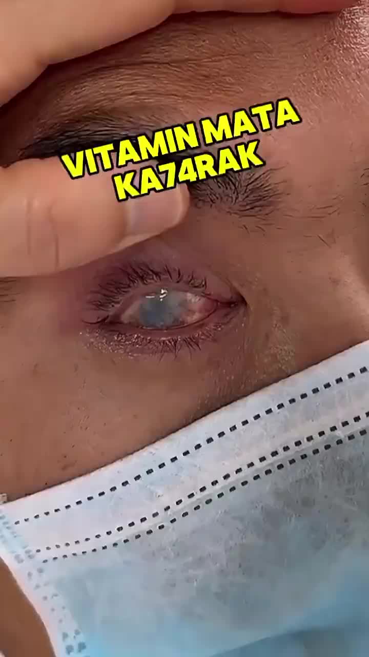 obat mata katarak obat tetes mata pembersihmata 13ml Obat mata minus Tetes mata obatmata berlemak Mata kering Sakit mata DarahMerah Ketegangan mata